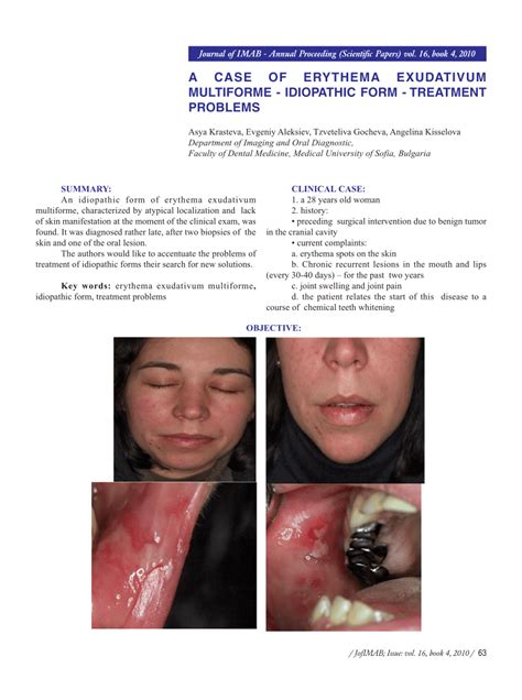 Pdf A Case Of Erythema Exudativum Multiforme Idiopathic Form Treatment Problems