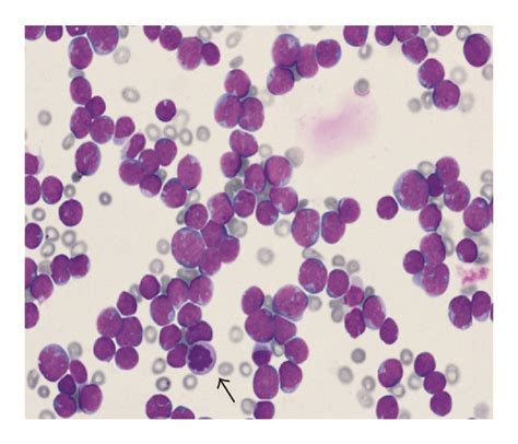 Csf Cytospin Preparation Smear X Shows Infiltration With Many