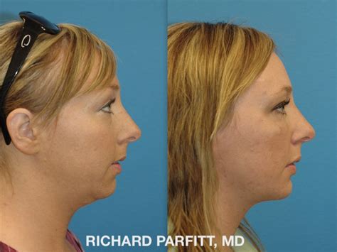 Chin Implant Photos Parfitt Facial Plastic Surgery Center