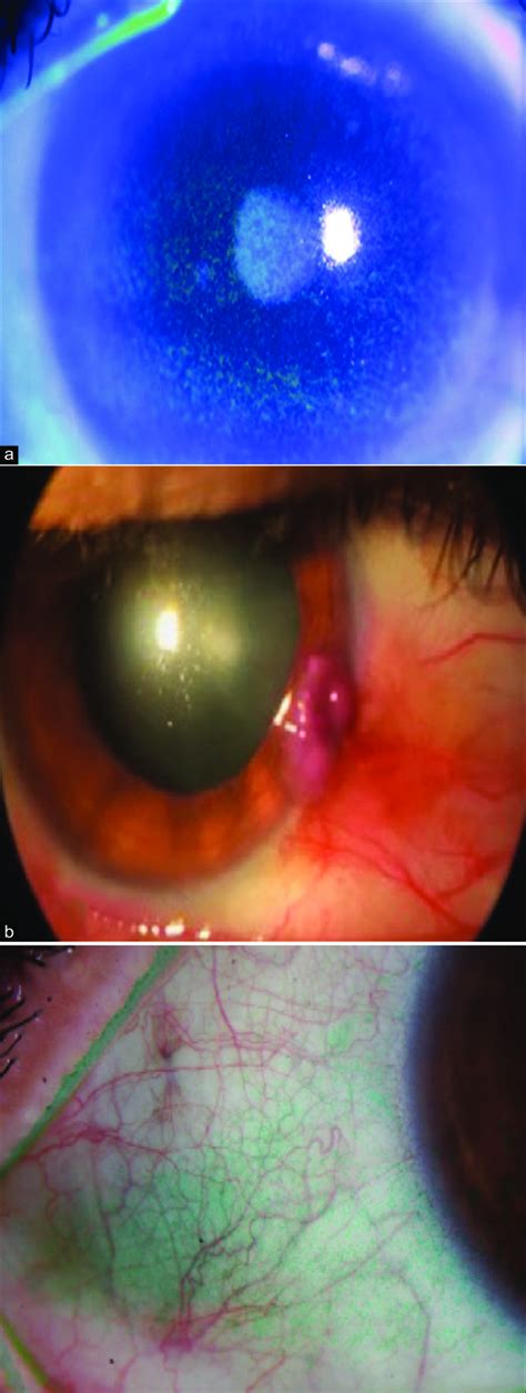 A Punctate Corneal Staining Demonstrated Using Fluorescein Dye And Download Scientific