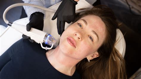 Everything You Need To Know About Radiofrequency Microneedling Tweak East