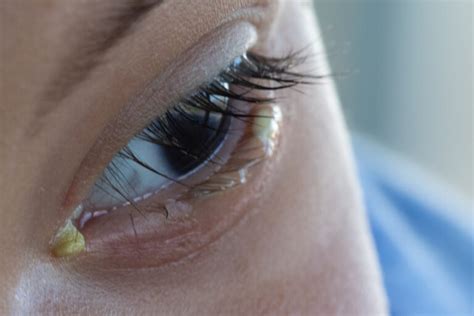 Crusty Eyes in the Morning: Causes & Treatment