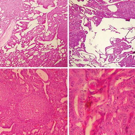 Microscopic appearance of Cribriform morular variant of papillary ...