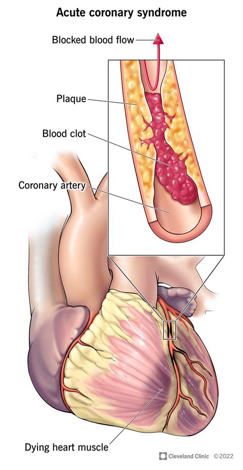 Acute Coronary Syndrome ACS Causes Symptoms Treatment