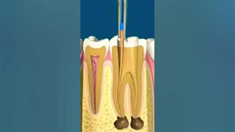 Root Canal Procedure Endodontic Treatment Dental Procedure Pulp Becomes Inflamed Or