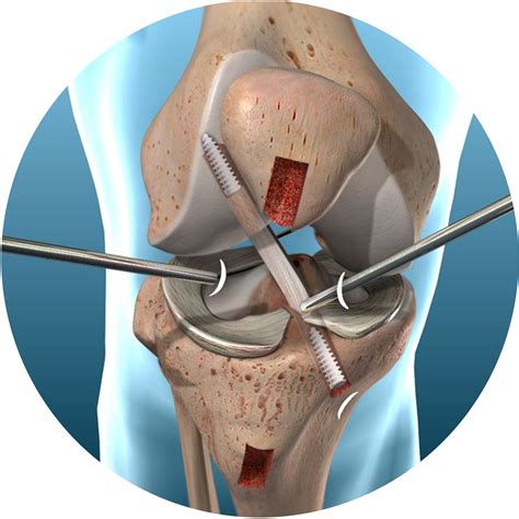 Lesi N De Ligamento Cruzado Anterior