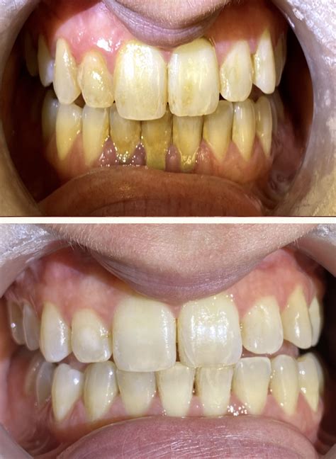 Teeth Cleaning Before And After