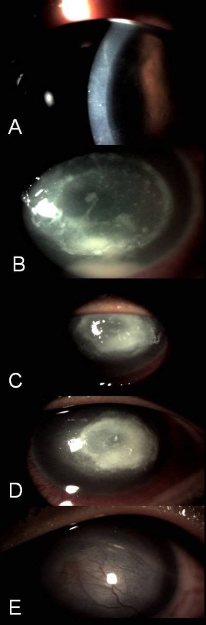 Clinical Course Of Unilateral Acanthamoeba Keratitis In A Cosmetic