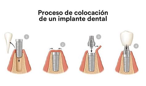 Cómo es el proceso de colocación de un implante Santident