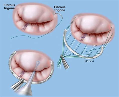 Minimally Invasive Heart Valve Surgery in Delhi | Dr S K Sinha