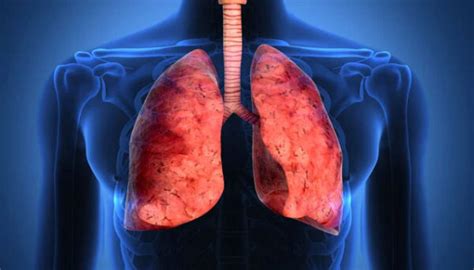 Fibrosis Pulmonar Qu Es S Ntomas Recomendaciones Atenci N M D