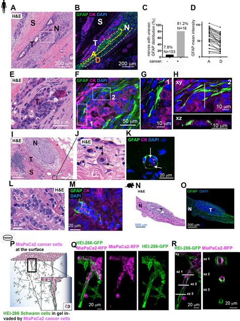 SCs Wrap And Align Cancer Cells A H E Section Of A Human PDAC