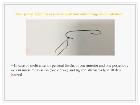 PPT SETON SURGICAL Traetement For Peri Anal Fistula What Causes An Anal Fistula PowerPoint