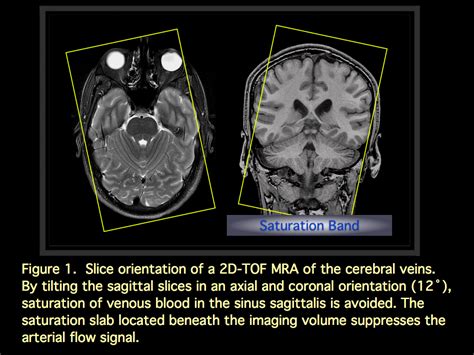 MRI BLOG: Dural Sinus Thrombosis