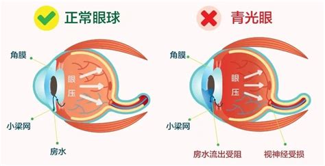 意想不到！糖尿病竟会引起这么多眼病？ 哔哩哔哩