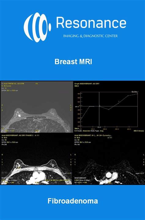 Breast MRI Is A Powerful Tool Since It Is Able To Detect Cancer Not