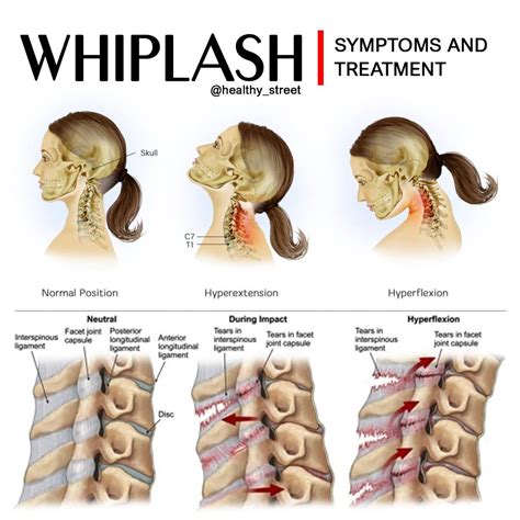 Whiplash Neck