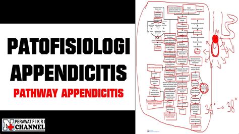 Patofisiologi Appendicitis Pathway Appendicitis I Download File Cek Link Di Deskripsi Youtube