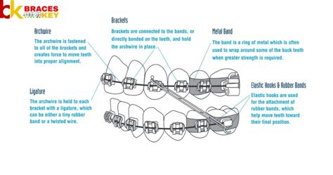 Braces Wire Size Chart - Braces Key