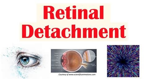 Retinal Detachment Types Risk Factors Pathophysiology Signs And Symptoms Diagnosis