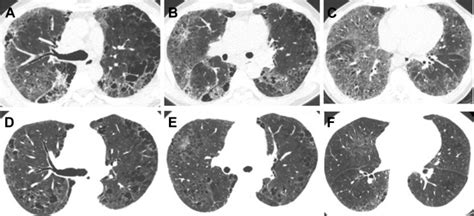 Imaging Of Smoking And Vaping Related Diffuse Lung Injury Radiologic