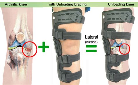 OA Unloader Knee Brace - Lateral – Orthomen