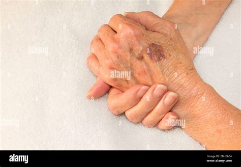 Bruises hi-res stock photography and images - Alamy