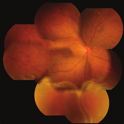 Fundus Photograph Of The Patient S Right Eye Obtained At The Initial Download Scientific