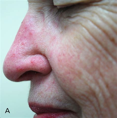 Rosacea Nose