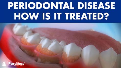 Periodontitis And Its Influence On Health How Is Periodontal Disease