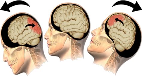 Traumatic Brain Injury Flashcards Quizlet