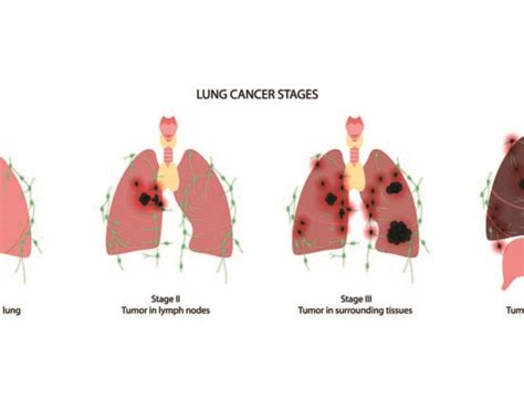 Lung Cancer Health365