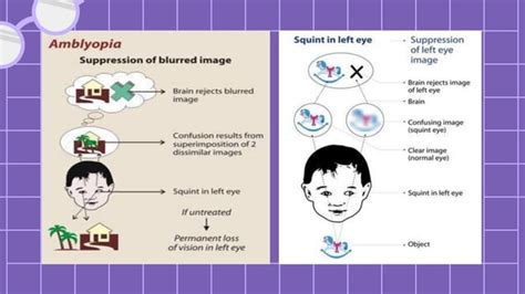 Visual Axis Deprivation Amblyopia Pdf