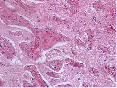 Perivascular Proliferations Of Meningothelial Cells Characterize