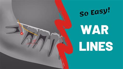 War Lines Oral Surgery Free Notes Youtube