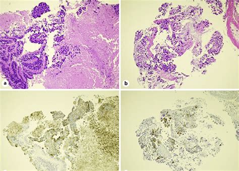 Photomicrographs Of Tblb Specimens From Both Lung Tumors Showing Both Download Scientific