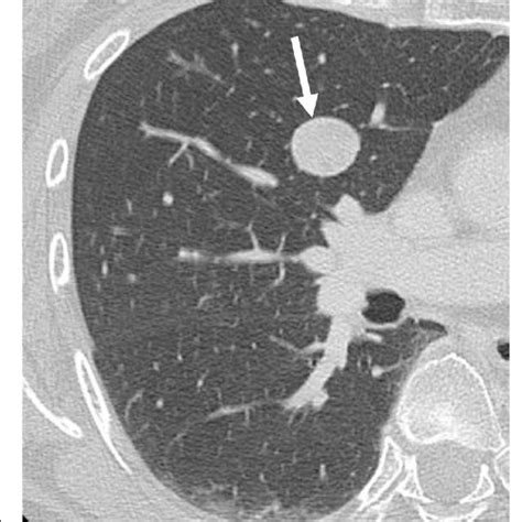 Chest Computed Tomography Ct Scan Obtained 5 Years After The First