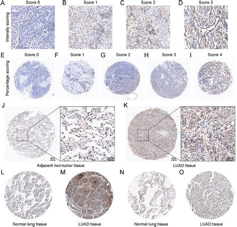 The Protein Expression Of Dsg In Luad Tissues And Non Tumor Tissues