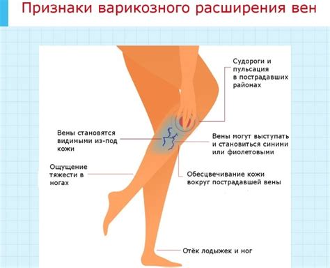 Мази для вен и сосудов на ногах, лекарства, народные средства, методы ...