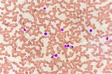 Photomicrograph of hematological slide showing monocytosis. Abnormal monocyte. 14261284 Stock ...