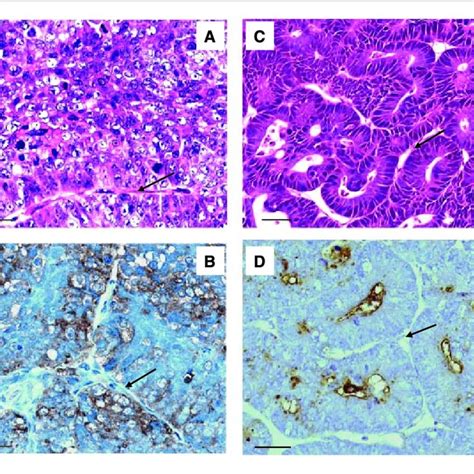 Three Dimensional Tumor Microvascular Architecture As Shown By