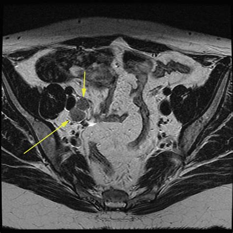 Cervical Lymph Nodes Radiology