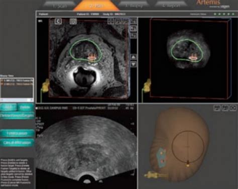 Mritrus Fusion Biopsies Why Mritrus Prostate Biopsy Sperling Prostate Center