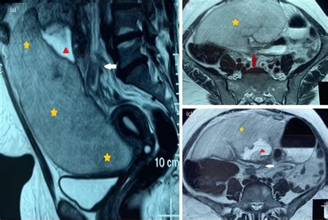 An Infarcted Wandering Spleen Leading To A Sigmoid Volvulus Presenting