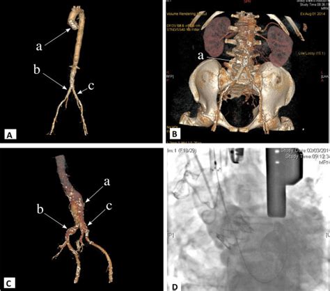 A 3 Dimensional Reconstruction Of The Aorta And Arterial Tree