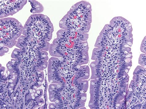 Non Neoplastic And Inflammatory Disorders Of The Small Bowel Clinical