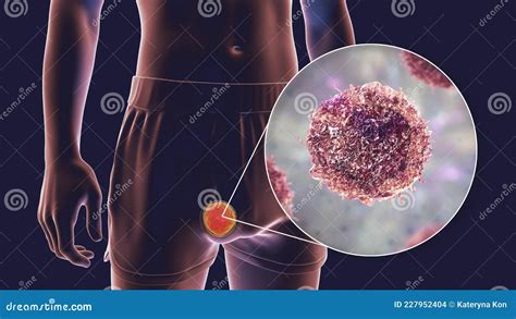 Testicular Cancer Symptoms Infographics Pictogram Icons Testicular