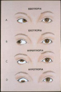 Amblyopia. Causes, symptoms, treatment Amblyopia