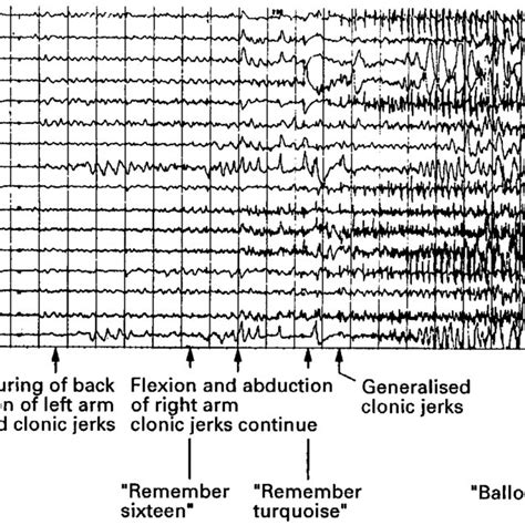 Pdf Painful Generalised Clonic And Tonic Clonic Seizures With