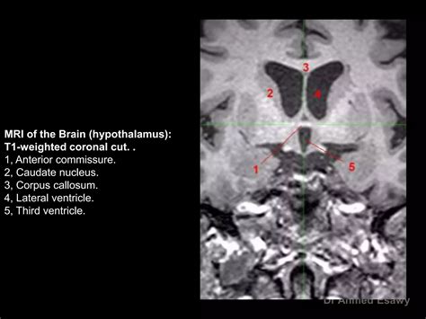 Mri Imaging Hypothalamus Dr Ahmed Esawy Ppt